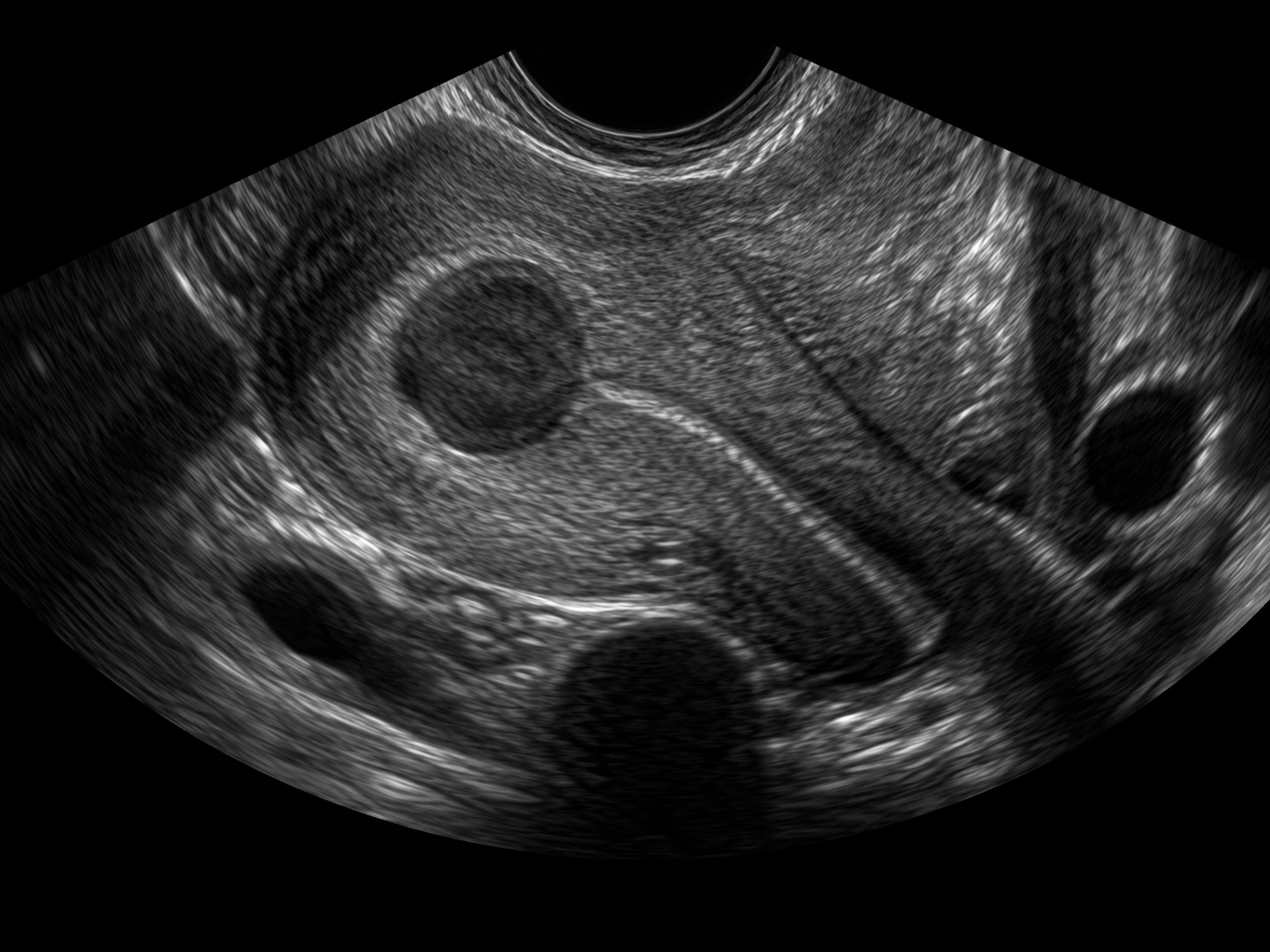 Imagem ilustrativa de ultrassonografia com mioma uterino